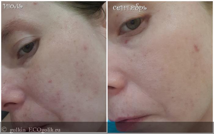  Anti-acne  Smorodina c     ,     -   gulkin