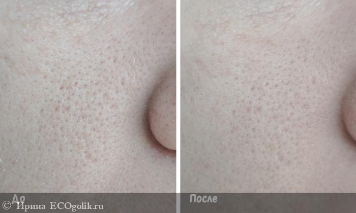        Stop Acne Mask  MATSESTA -   