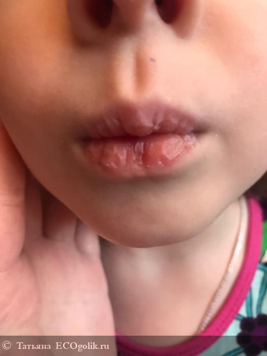 Обветривание губ у ребенка: как избежать неприятностей?