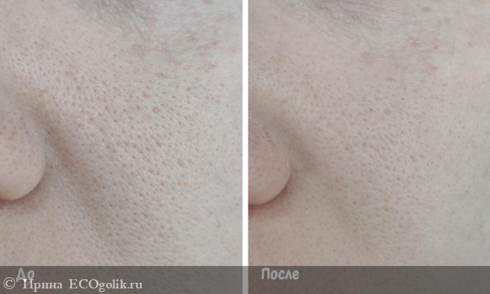        Stop Acne Mask  MATSESTA -   