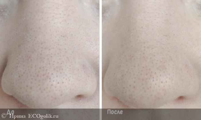        Stop Acne Mask  MATSESTA -   