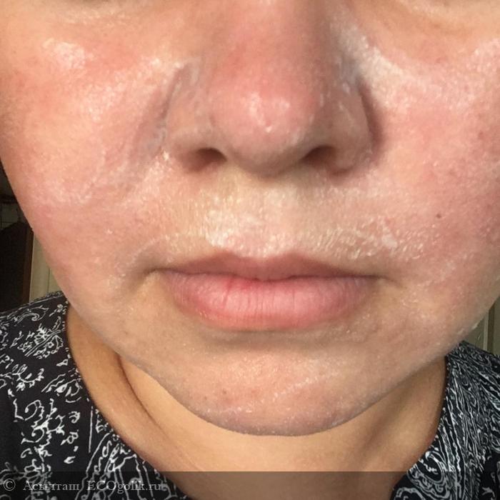 Аллергия на хозяйственное мыло фото